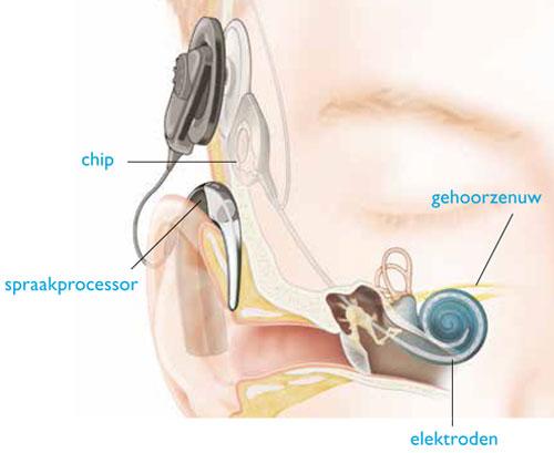 Cochleair implant