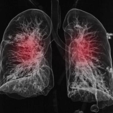 COPD rokerslong