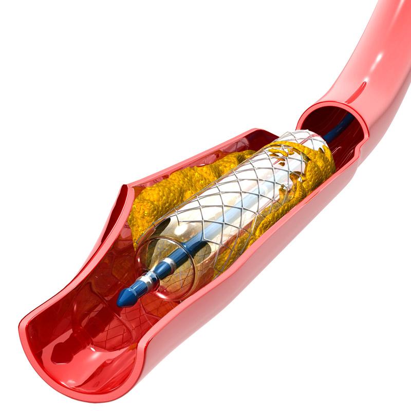 Drug-eluting stent