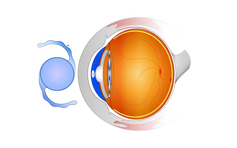 Lens implantaat 