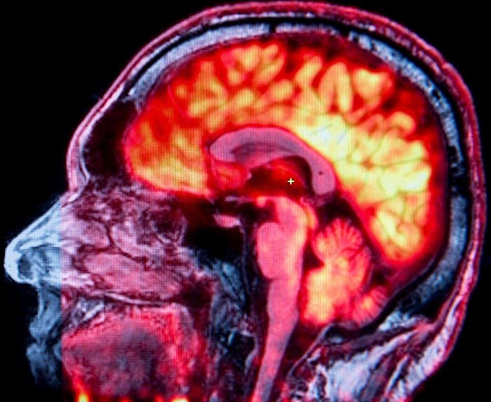 beeld van hoofd in PET-MR scan