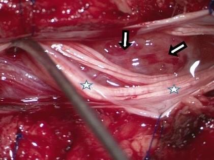 Tumor wordt losgemaakt van de cauda equina 