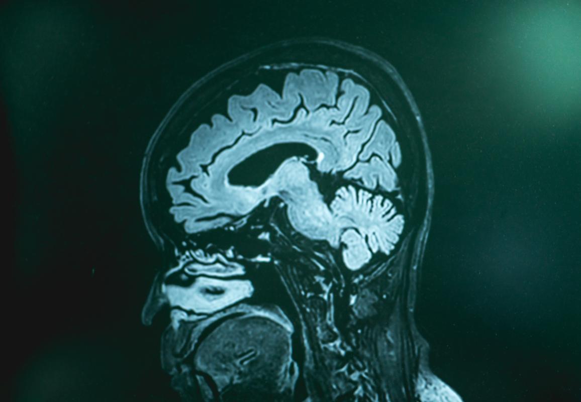 MRI-beeld hersenen