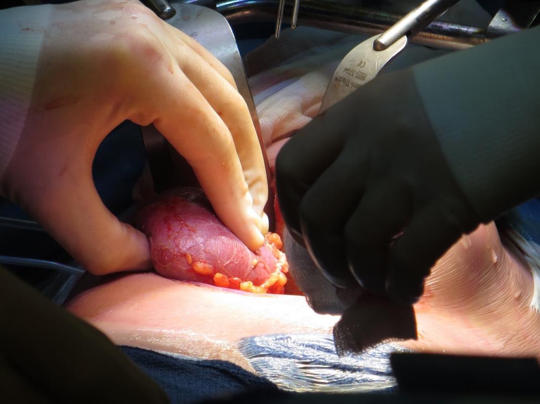 Orgaantransplantatie bij kinderen