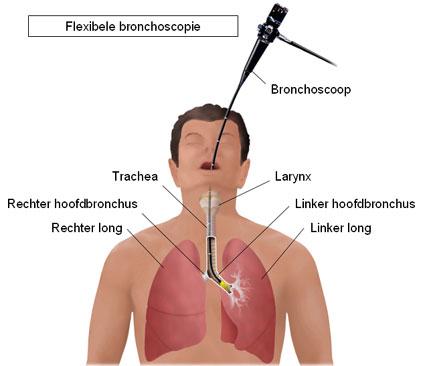 Flexibele bronchoscopie