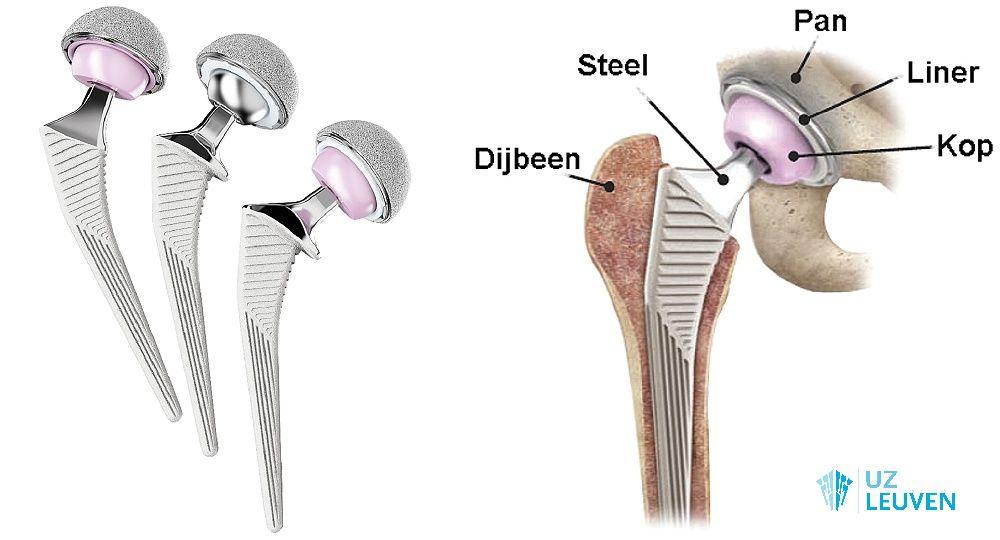 Soorten heupprothese (links) en onderdelen van heupprothese (rechts)