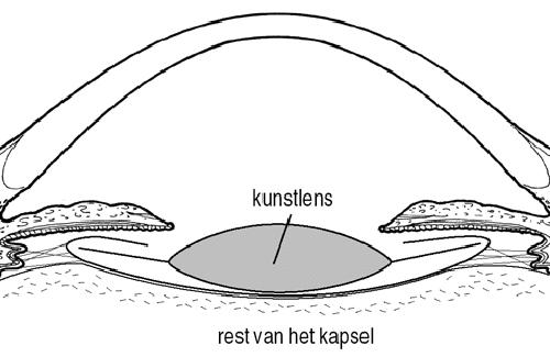 De rest van het kapsel blijft zitten. In dit soort 'zakje' wordt vervolgens een plastic kunstlens geplaatst.