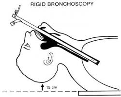 Rigide bronchoscoop