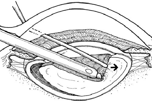 De lens wordt verbrijzeld en weggezogen met fijne instrumenten onder een microscoop. Hier wordt eerst kern van de lens verwijderd. 