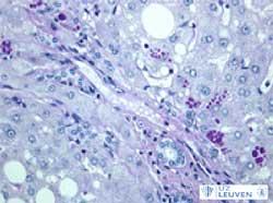 Leverbiopsie voor opsporen eiwit alfa-1-antitrypsine toont paarse verkleuring