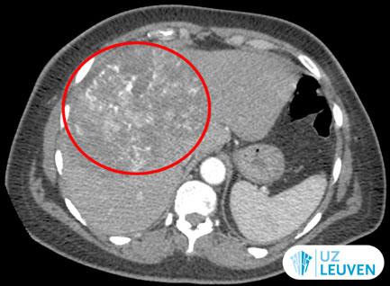 CT-scan van angiosarcoma.