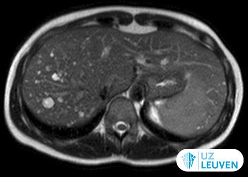 MRI beeld van biliaire hamartomen: bemerk de mutipele levercystjes.