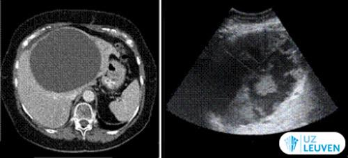 Geïsoleerde bilaire cyste met bloeding (voor en na)