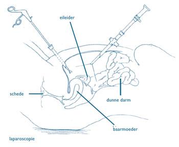 Laparoscopie