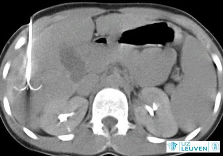 CT-scan van lever waarin HCC zich heeft ontwikkeld, behandeld met RFA