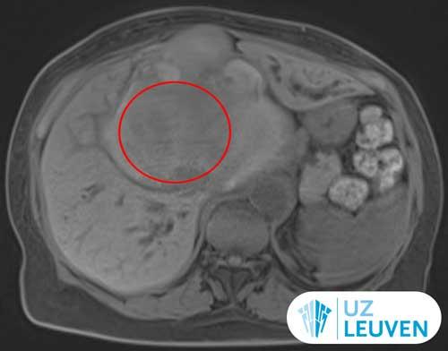 Cystadenocarcinoom in de lever