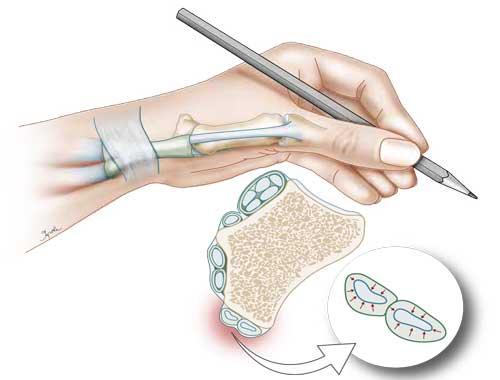 De Quervain tendinitis