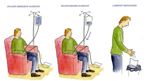 Peritoneale dialyse met uitloop en inloop van spoelvloeistof