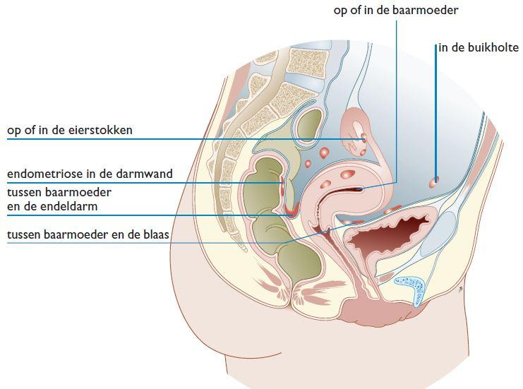 Waar komt endometriose voor