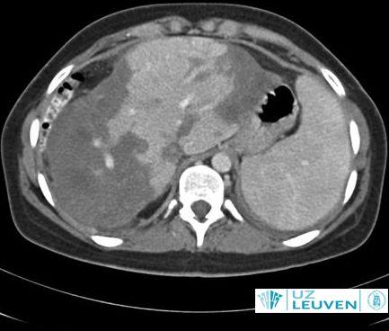 CT-scan van epitheloïd haemangio-endothelioma, grote letsels met soms verkalkingen en intrekking van het leverkapsel.