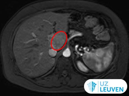 MRI-scan van een focaal nodulaire hyperplasie