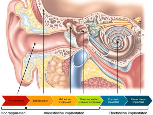Gehoorverlies: oplossingen en behandelingen