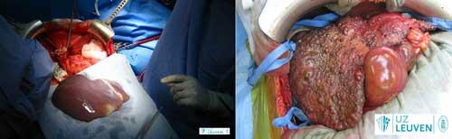 Normale lever (links) en een cirrotische lever (rechts)