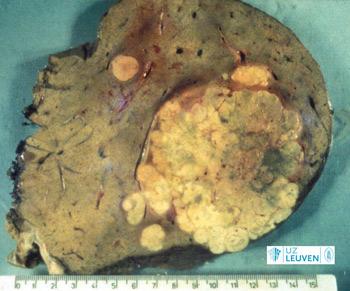 Operatiestuk van een hepatocellulair carcinoom (1 grote tumor met kleine satellietletsels in de omgeving)