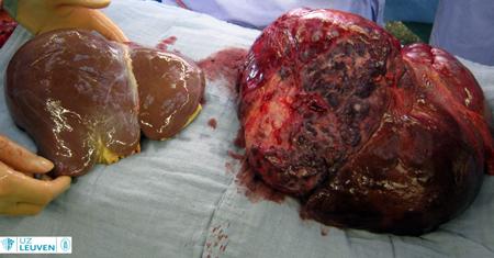 Normale lever (links) en lever met giant hemangioom (rechts)