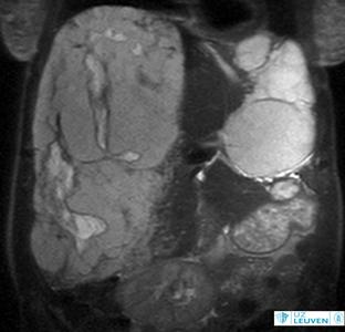 MR-scan van lever met giant hemangioom