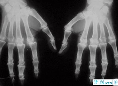 Hemocromatose in gewrichten