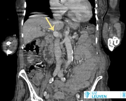 Aangeboren verbinding tussen poortader en vena cava.