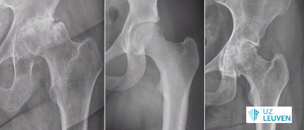 Gezonde heup (midden), heupartrose (links en rechts)