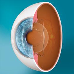 Implanteerbare contactlens (ICL)