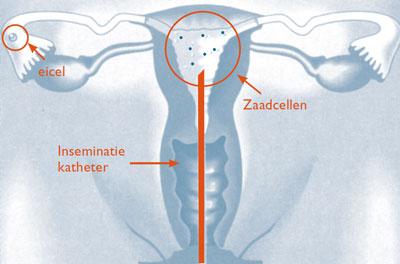 IUI | UZ Leuven