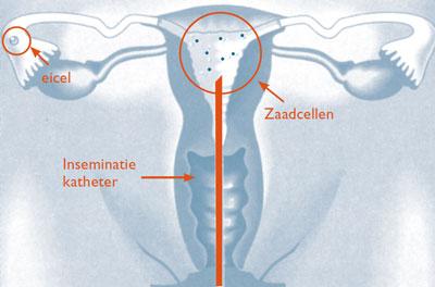 Intra-uteriene inseminatie