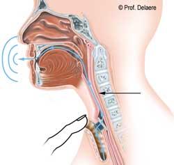 laryngectomie