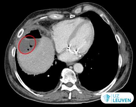 CT-scan van leverabsces met gasvorming