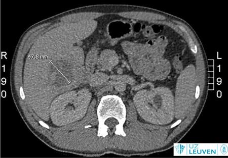 CT-scan van lever met hypodensleverletsel zonder aantoonbaar contrastcaptatie: leverabsces.