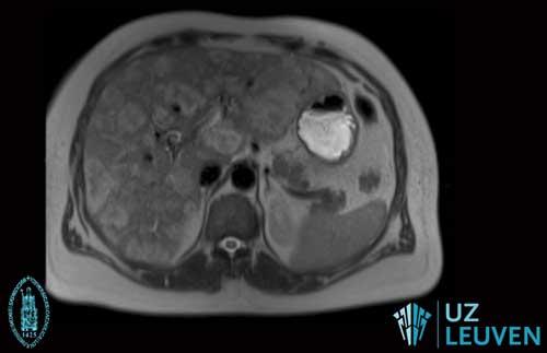 MR-scan van de lever met meerdere gezwellen.