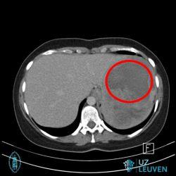 Leveradenoom in de linker leverlob dat gebloed heeft.