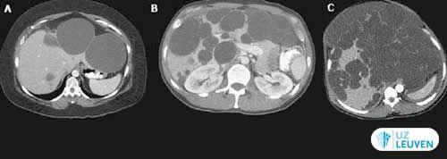 CT-scan van de lever: verschillende gradaties van de ernst van leverpolycystose.