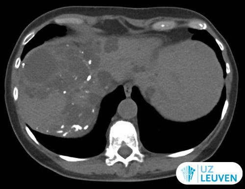 Calcificaties in levercysten als een uiting van vroegere verwikkelingen (infectie of bloeding)