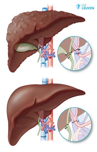 Levertransplantatie