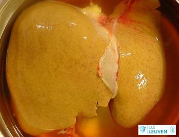 Steatotische lever (bemerk de gele kleur, uitgelokt door het vet in de lever)