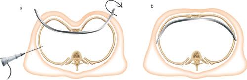 nuss-operatie: gebogen staven worden achter borstbeen geplaatst en duwen dit in een normale positie
