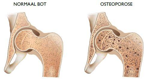 Osteoporose