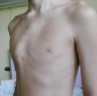 Pectus carinatum