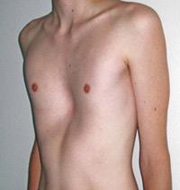 Pectus excavatum