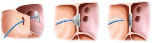 Percuntane sluiting van atriaal septum defect met behulp van klein 'parapluutje'.